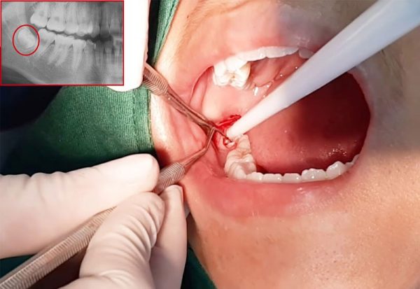 Răng số 8 bị sâu vỡ: Nguyên nhân và giải pháp khắc phục | TCI Hospital