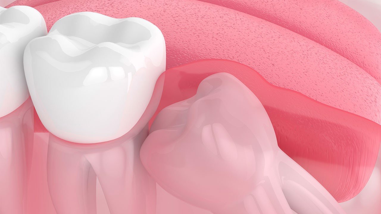  Nhổ răng số 8 mọc lệch - Tìm hiểu vị trí răng mực trong miệng