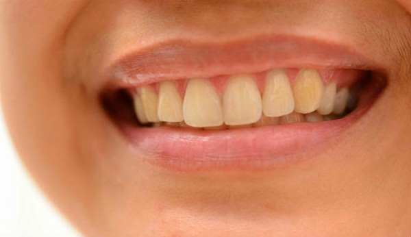 Răng trắng sáng
