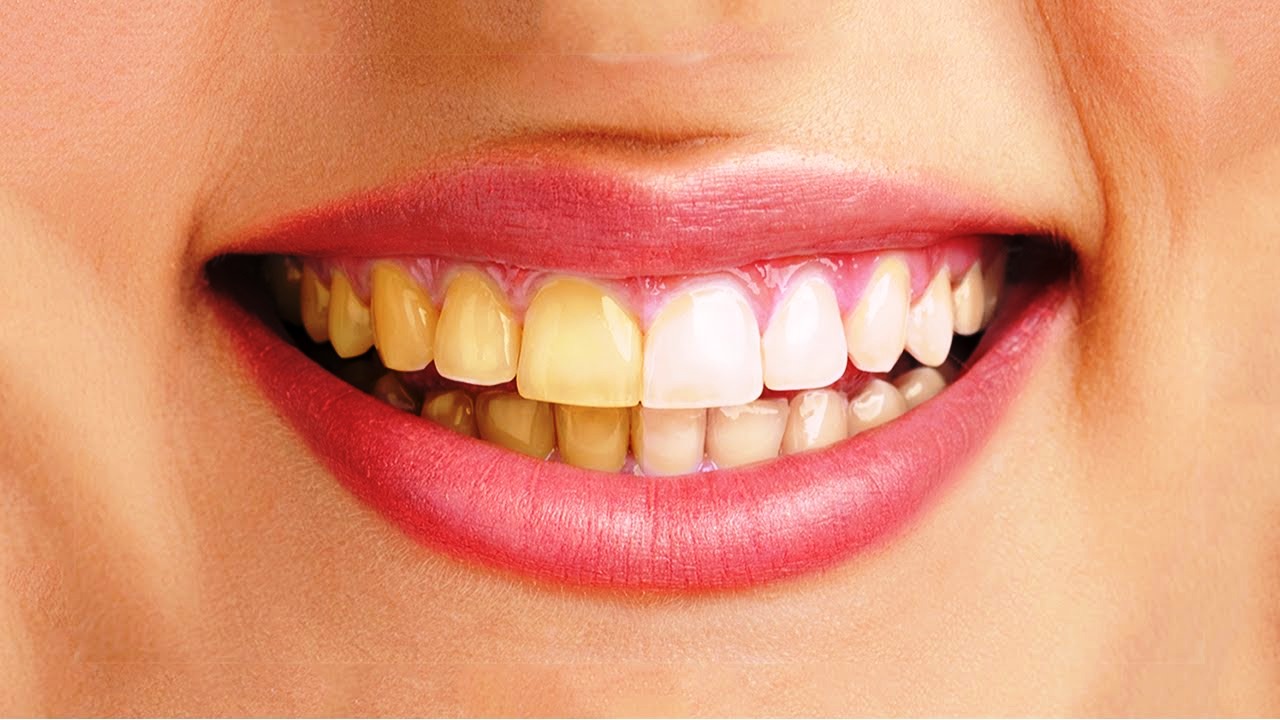 GIẢI ĐÁP: Răng vàng có tẩy trắng được không? | TCI Hospital