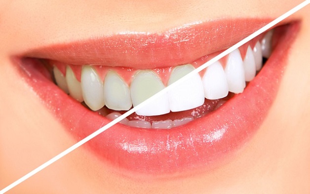 Tẩy trắng răng là phương pháp sử dụng oxy hóa thấm qua lớp men, kết hợp cùng năng lượng ánh sáng để tạo ra phản ứng oxy hóa nhằm cắt đứt chuỗi phân tử màu ở trong ngà răng