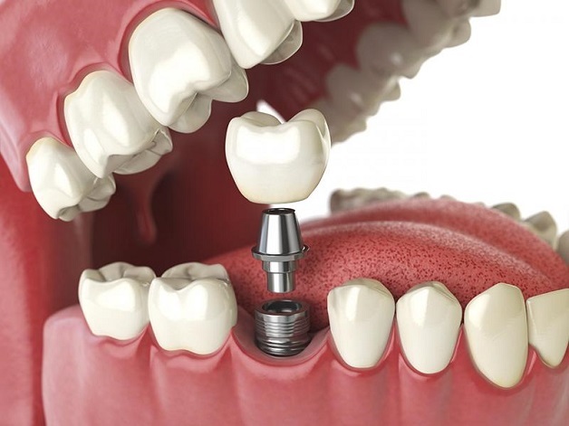 Trồng răng sứ là dạng kỹ thuật thẩm mỹ nha khoa đem lại tác dụng phục hình thẩm mỹ cho răng