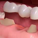 GIẢI ĐÁP: Trồng răng sứ có đau không?