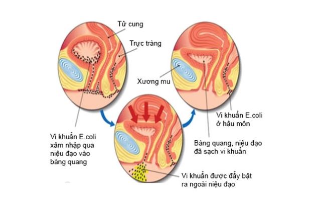 Điều trị viêm đường tiết niệu ở trẻ em gái