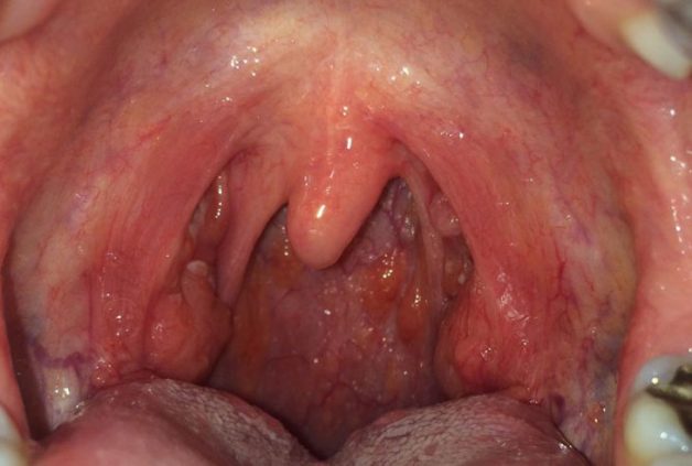 Viêm họng hạt là bệnh gì