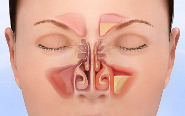 Viêm mũi xoang mạn tính là tình trạng viêm các xoang cạnh mũi kéo dài trên 8 tuần