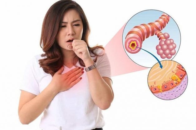 Viêm phế quản sẽ xảy ra khi niêm mạc phế quản từ vùng thanh quản đến nhu mô phổi bị viêm nhiễm