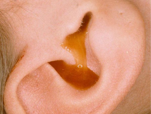 Viêm tai giữa tiết dịch là một trong những bệnh lý “im lặng” của tai giữa, thường không có triệu chứng rõ ràng nên rất khó phát hiện bệnh ở giai đoạn sớm.