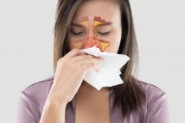 Hiện tượng chảy dịch là triệu chứng phổ biến nhất của người bị viêm xoang.