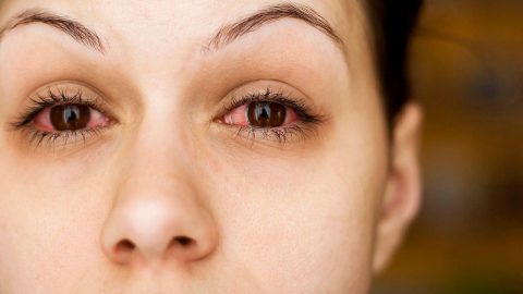 Bệnh đau mắt đỏ và những kiến thức cơ bản nên biết