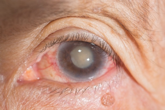 Bệnh đục thủy tinh thể mắt (hay còn gọi là cườm đá, cườm khô) là căn bệnh thường gặp nhiểu ở người lớn tuổ