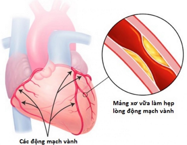 bệnh tim mạch vành là gì