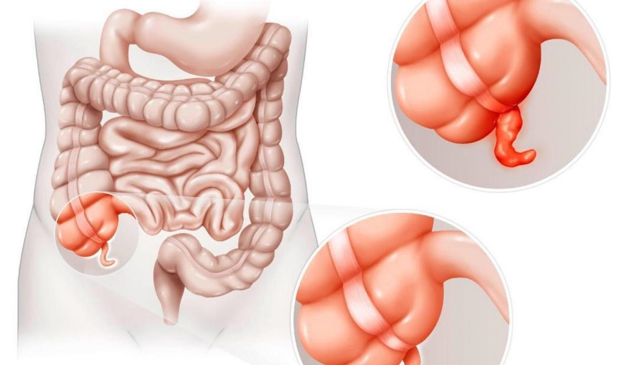 Dấu hiệu nhiễm trùng phổ biến có thể xuất hiện ở người bị viêm ruột thừa là gì?

