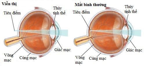 Viễn Thị Có Chữa Được Không? Khám Phá Giải Pháp Hiệu Quả