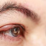 Hướng dẫn cách điều trị viêm bờ mi mắt hiệu quả và an toàn