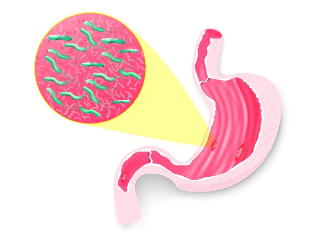 Có vi khuẩn HP trong dạ dày gây viêm loét dạ dày