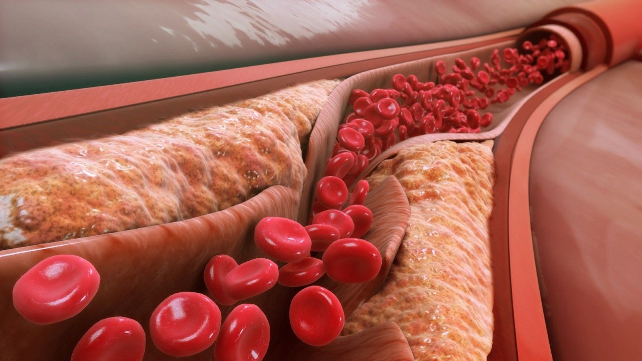 Bệnh mạch vành có liên quan đến lối sống không?
