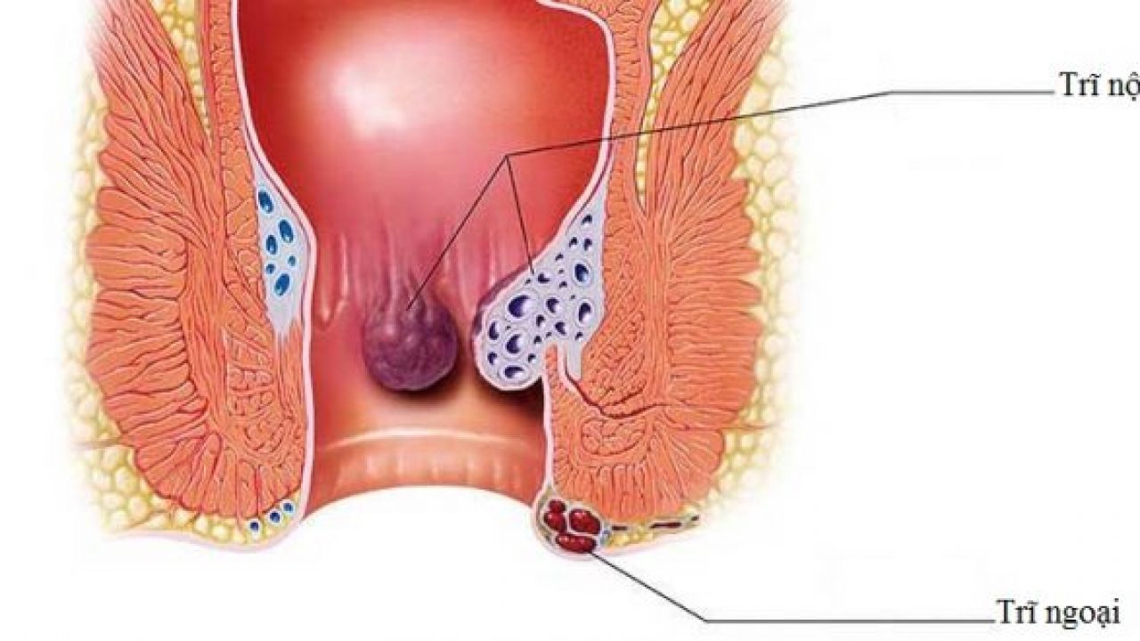 Thói quen sinh hoạt và ăn uống nào có thể giúp điều trị trĩ ngoại độ 1?
