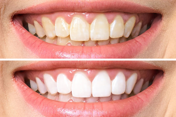 Sau khi tẩy trắng, răng sẽ trở nên đều màu và trắng sáng hơn so với ban đầu