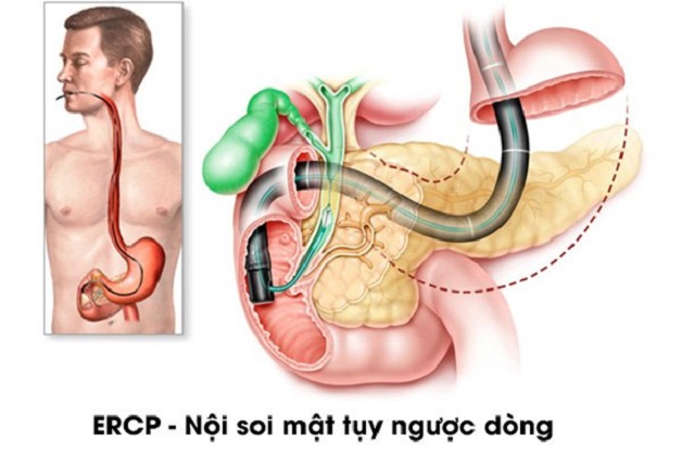 Giúp bạn hiểu rõ về kỹ thuật nội soi mật tụy ngược dòng