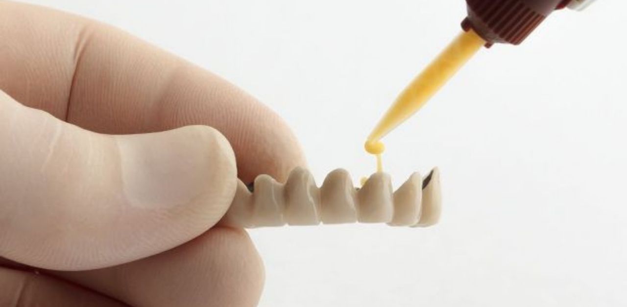 Quá trình thực hiện bọc răng sứ cố định bằng keo dán như thế nào?
