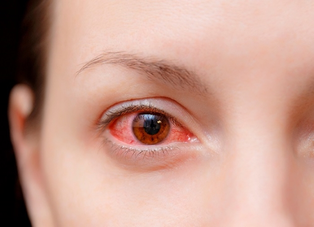 Viêm kết mạc dị ứng là bệnh lý xảy ra khi mắt tiếp xúc với một dị nguyên gây kích thích kết mạc