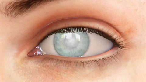 Loạn dưỡng giác mạc nguy hại cho mắt như thế nào?