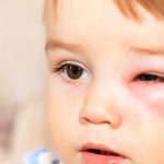 Nguyên nhân viêm bờ mi mắt là gì? Cách điều trị ra sao?