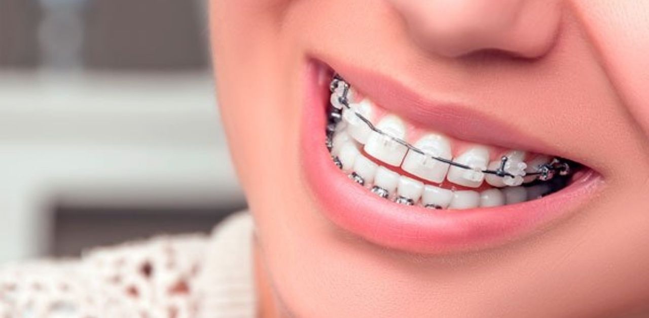 Phương pháp niềng răng nào phù hợp nhất cho tình trạng răng thưa?

