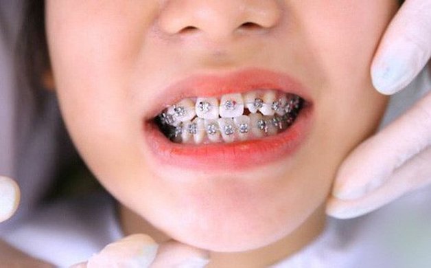 Niềng răng cho trẻ áp dụng cho những trường hợp trẻ có những sai lệch ở răng miệng như: Răng khấp khểnh, răng quá thưa, hô, móm...