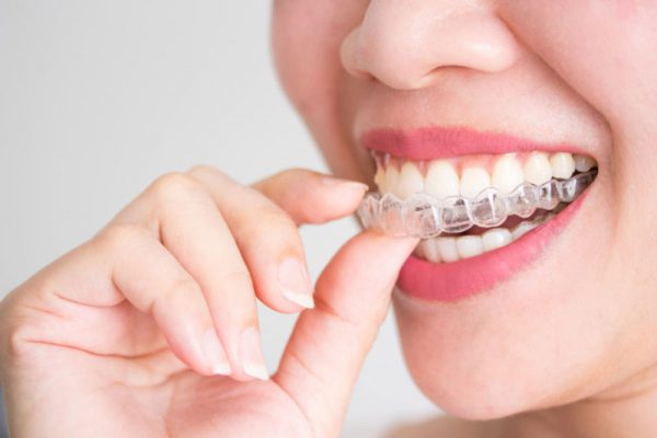 Niềng răng không cố định là phương pháp sử dụng máng hoặc các khay niềng đeo vào răng để nắn chỉnh răng về đúng vị trí mong muốn trên cung hàm. 