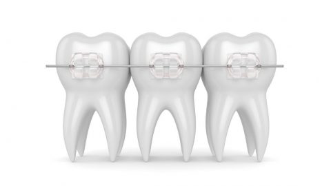 Niềng răng mắc cài sứ trong suốt – Phương pháp chỉnh nha thẩm mỹ