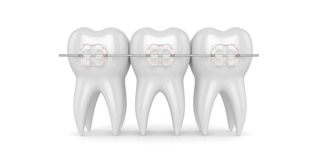Tại sao niềng răng mắc cài sứ trong suốt được phổ biến?
