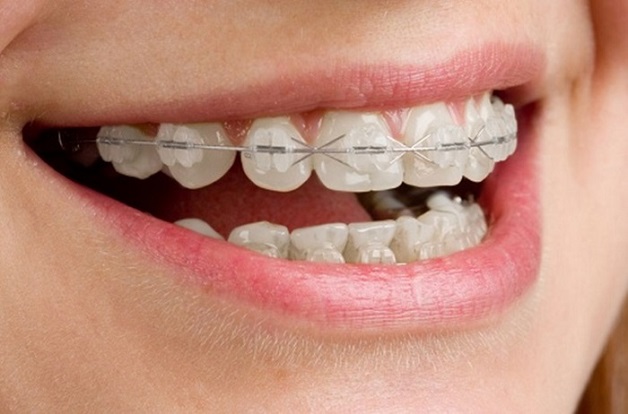 Niềng răng móm là giải pháp hữu ích giúp bạn cải thiện tình trạng móm do răng