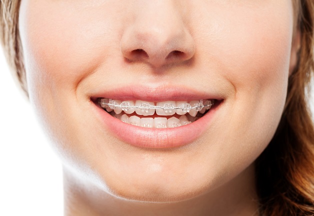 Niềng răng thưa mất thời gian bao lâu? | TCI Hospital