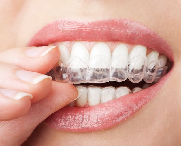 Niềng răng trong suốt bao nhiêu tiền còn phụ thuộc vào mức độ sai lệch ở răng