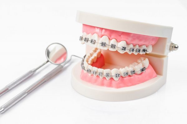 Niềng răng xong vẫn xấu phải làm sao? | TCI Hospital