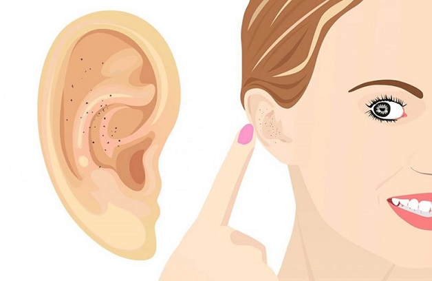 Mụn mọc ở vành tai có thể là dấu hiệu cảnh báo một số bệnh lý nghiêm trọng