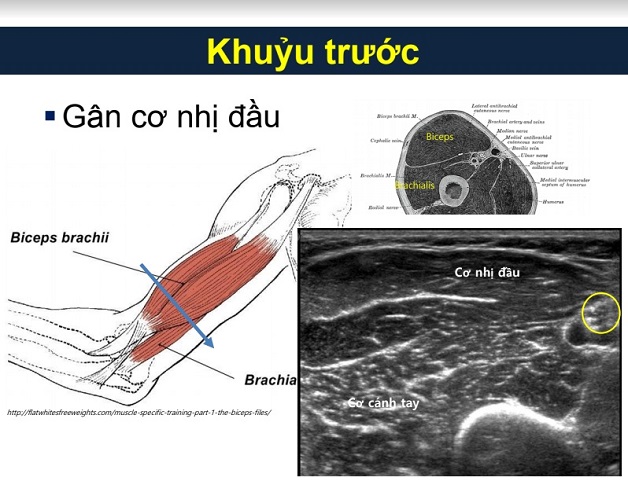 Siêu âm khớp khuỷu tay giúp phát hiện bệnh lý nào?