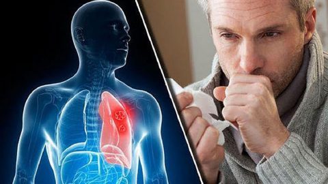9 triệu chứng ung thư phổi không nên bỏ qua