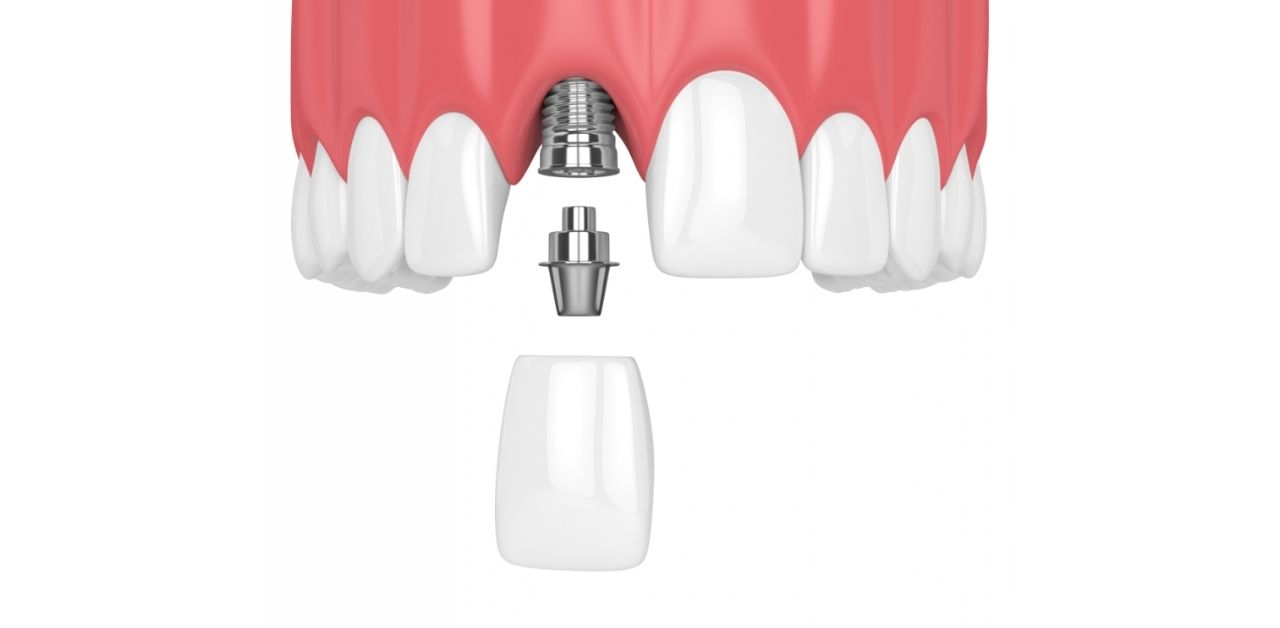 Абатмент на имплант что это. Имплантация абатмент коронка. Стандартный абатмент на имплант. Имплант винт абатмент коронка. Имплант с абатментом и коронкой.