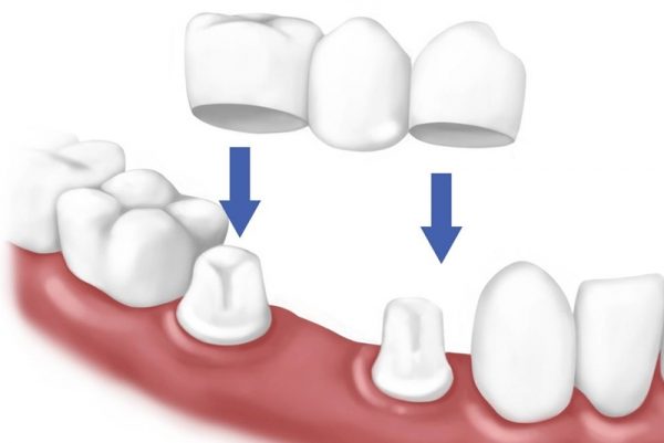 Phương pháp cầu răng sứ phục hình răng nanh bị mất