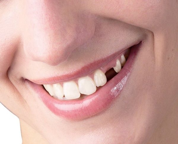 Răng nanh bị mất gây ra nhiều ảnh hưởng tới chức năng nhai và thẩm mỹ của khuôn mặt