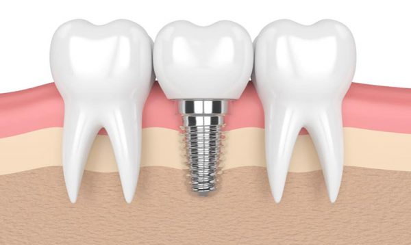 Cấy ghép Implant giúp khôi phục chức năng nhai và thẩm mỹ của răng nanh