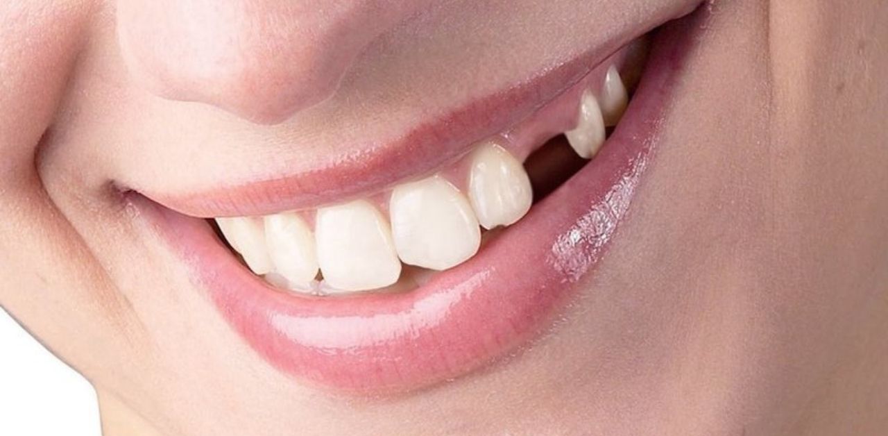 Trồng răng nanh có ảnh hưởng đến thẩm mỹ không?
