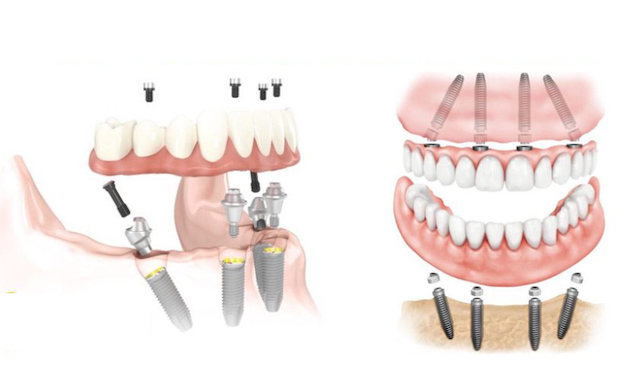 Trồng răng implant all on 4 là phương pháp phục hình răng dựa vào 4 trụ implant mỗi hàm.