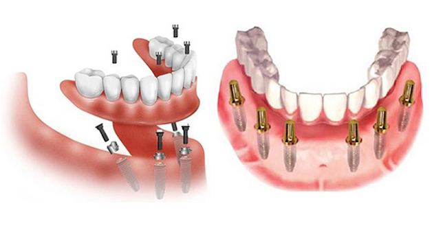Trồng răng nguyên hàm loại nào là tốt? | TCI Hospital