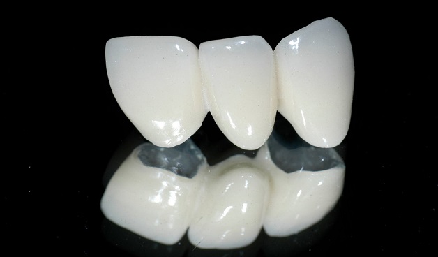  Răng sứ kim loại titan có cấu trúc tương tự với răng sứ kim loại