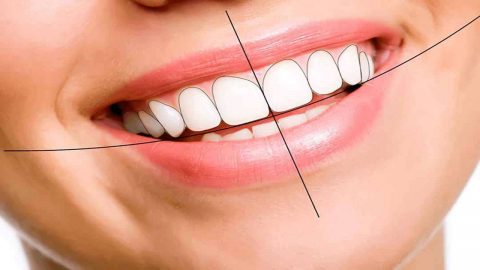 Trồng răng sứ nguyên hàm và những điều cần biết 