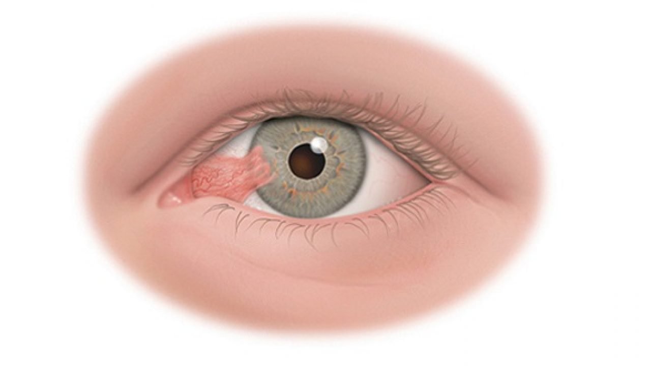 U kết mạc mắt có liên quan đến loại virus nào?

